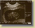 Week9-1st-Ultrasound-13Jul2011 (2) * 800 x 632 * (54KB)